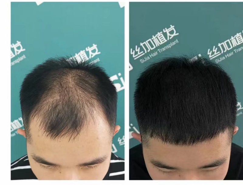 揭開(kāi)植發(fā)的神秘面紗:一次全新的重生之旅